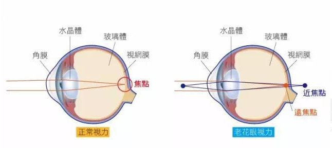 白內(nèi)障和老花眼區(qū)別，老花眼發(fā)病率正呈現(xiàn)年輕化趨勢(shì)